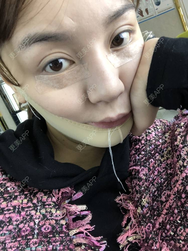 更美 - 炫雅的小迷妹💗的真皮丰卧蚕经验 | 真皮丰卧蚕 | 武汉