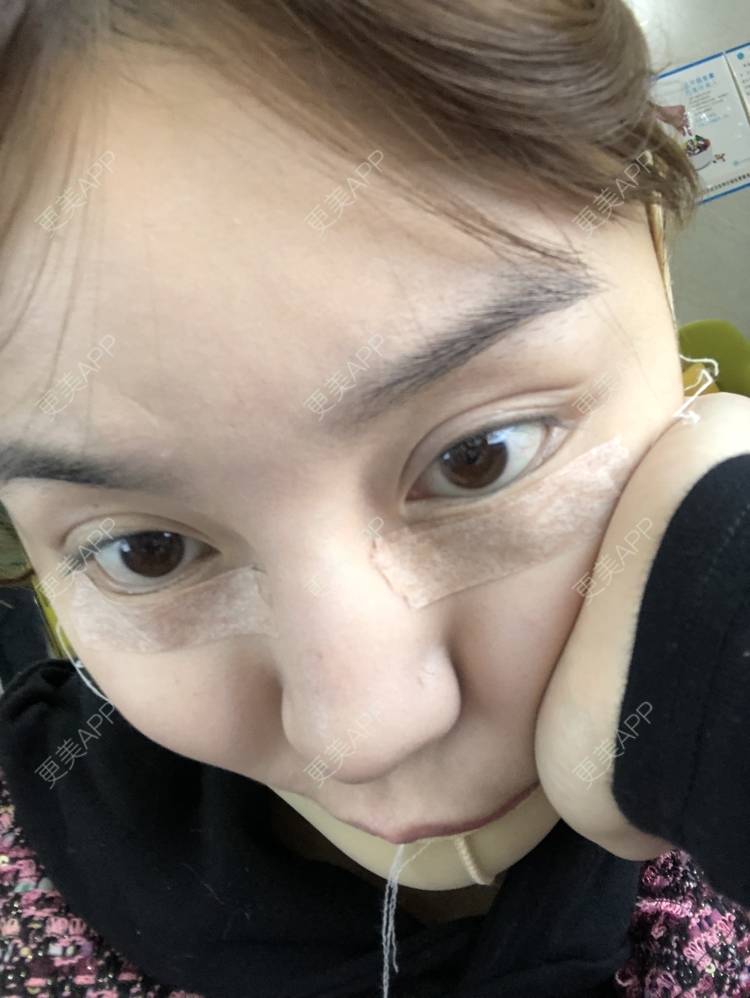 更美 - 炫雅的小迷妹💗的真皮丰卧蚕经验 | 真皮丰卧蚕 | 武汉