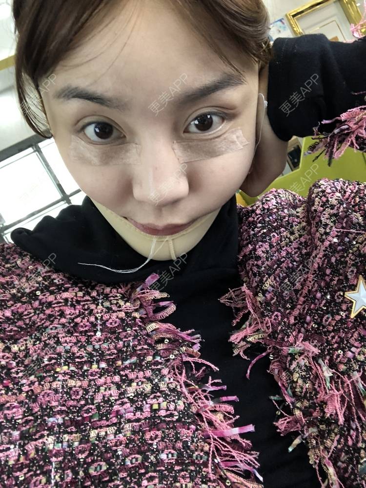更美 - 炫雅的小迷妹💗的真皮丰卧蚕经验 | 真皮丰卧蚕 | 武汉