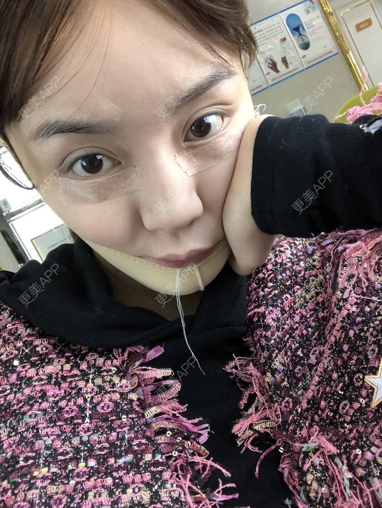 更美 - 炫雅的小迷妹💗的真皮丰卧蚕经验 | 真皮丰卧蚕 | 武汉