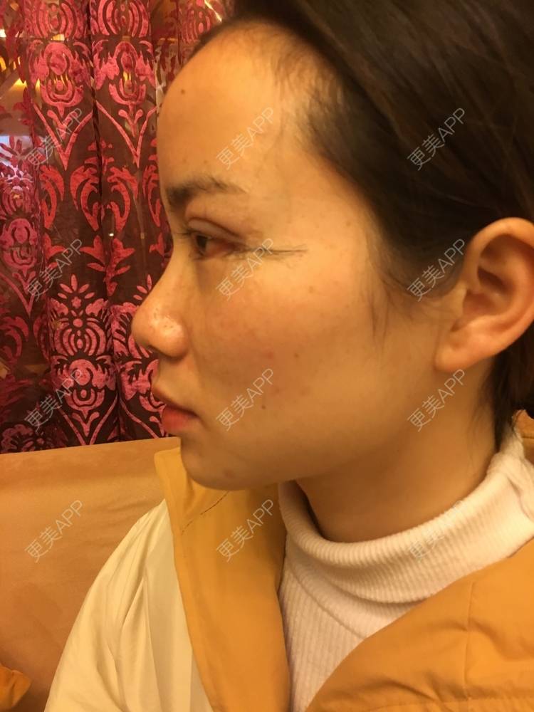 更美 - 更美用户222hTxLwTH的自体脂肪丰卧蚕经验 | 上海 | 自体脂肪丰卧蚕
