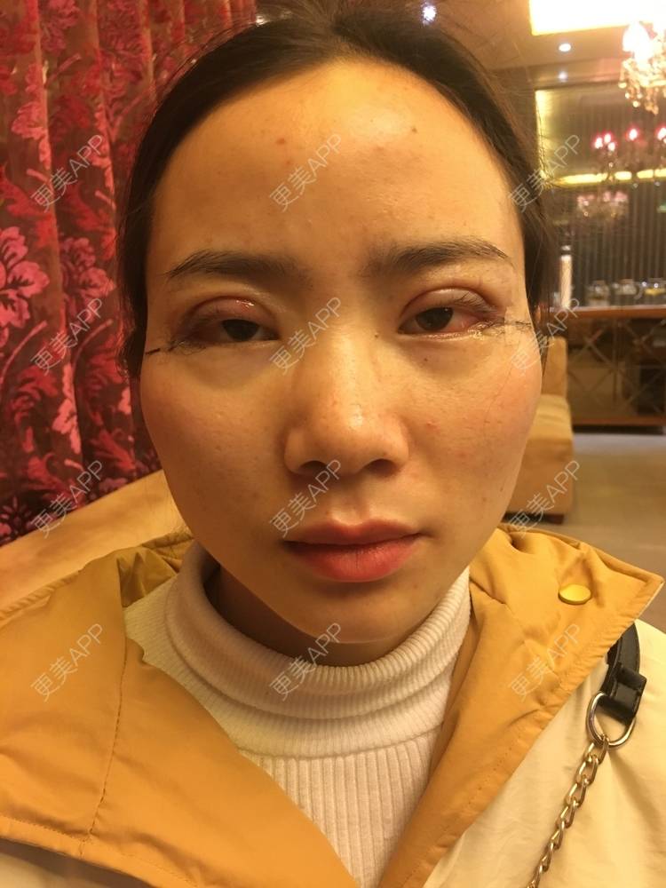 更美 - 更美用户222hTxLwTH的自体脂肪丰卧蚕经验 | 上海 | 自体脂肪丰卧蚕