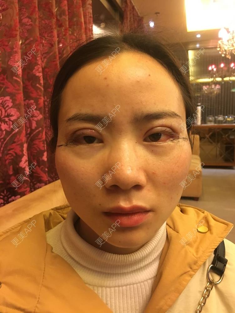 更美 - 更美用户222hTxLwTH的自体脂肪丰卧蚕经验 | 上海 | 自体脂肪丰卧蚕