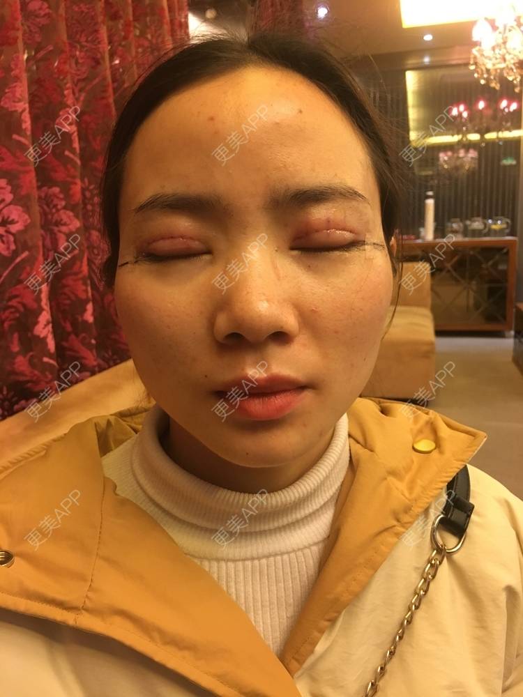 更美 - 更美用户222hTxLwTH的自体脂肪丰卧蚕经验 | 上海 | 自体脂肪丰卧蚕