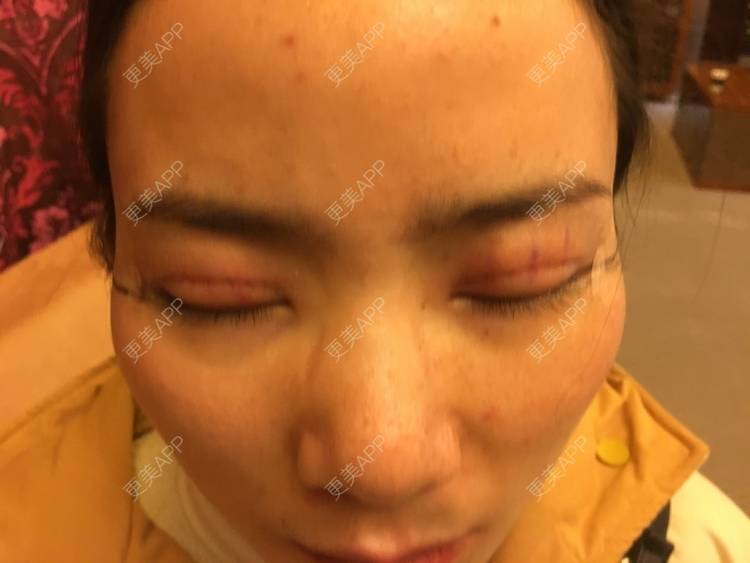 更美 - 更美用户222hTxLwTH的自体脂肪丰卧蚕经验 | 上海 | 自体脂肪丰卧蚕