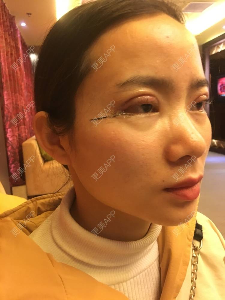 更美 - 更美用户222hTxLwTH的自体脂肪丰卧蚕经验 | 上海 | 自体脂肪丰卧蚕