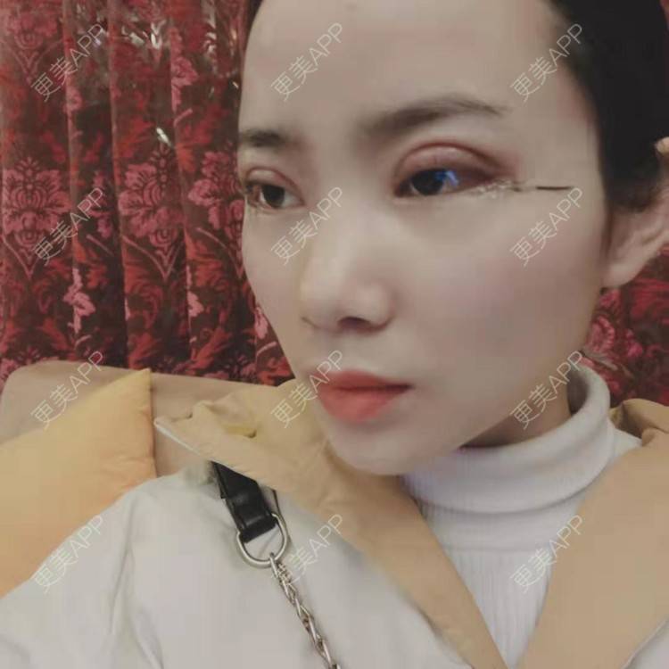 更美 - 更美用户222hTxLwTH的自体脂肪丰卧蚕经验 | 上海 | 自体脂肪丰卧蚕