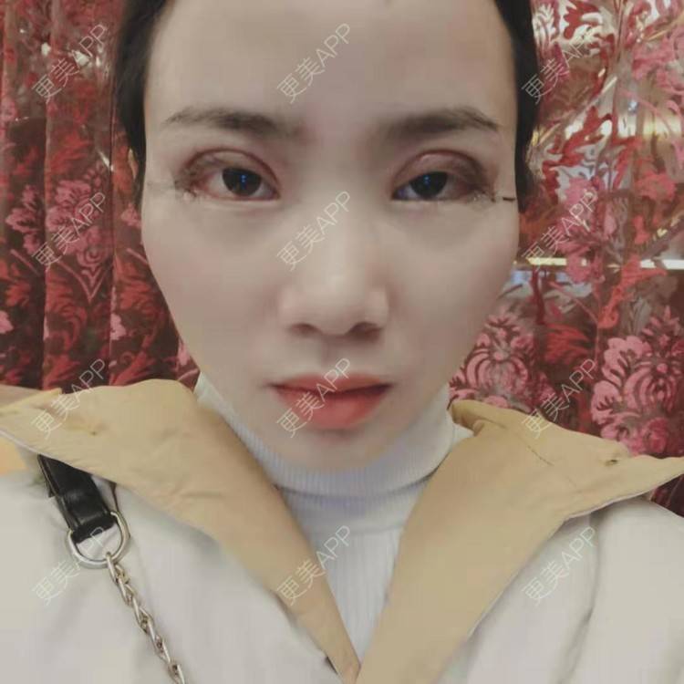 更美 - 更美用户222hTxLwTH的自体脂肪丰卧蚕经验 | 上海 | 自体脂肪丰卧蚕