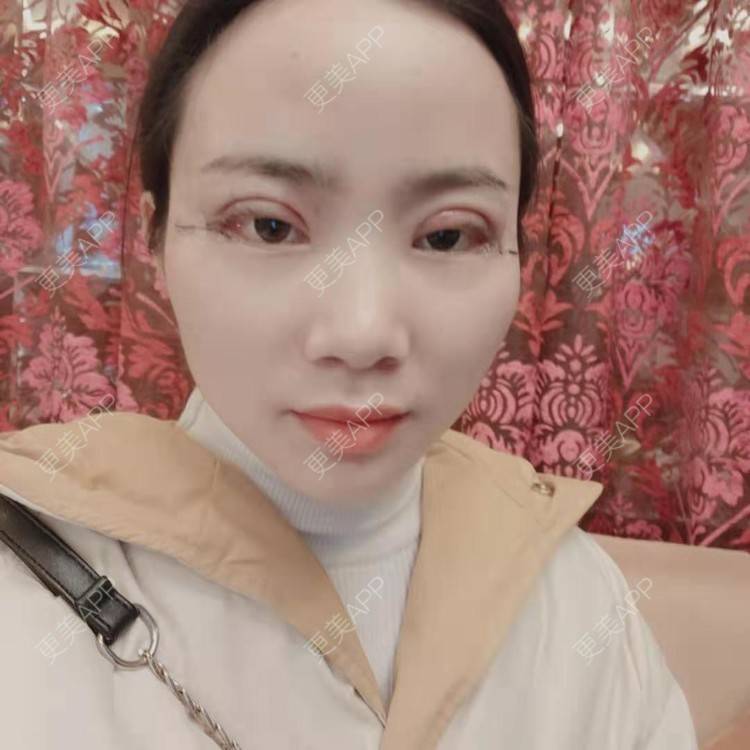 更美 - 更美用户222hTxLwTH的自体脂肪丰卧蚕经验 | 上海 | 自体脂肪丰卧蚕
