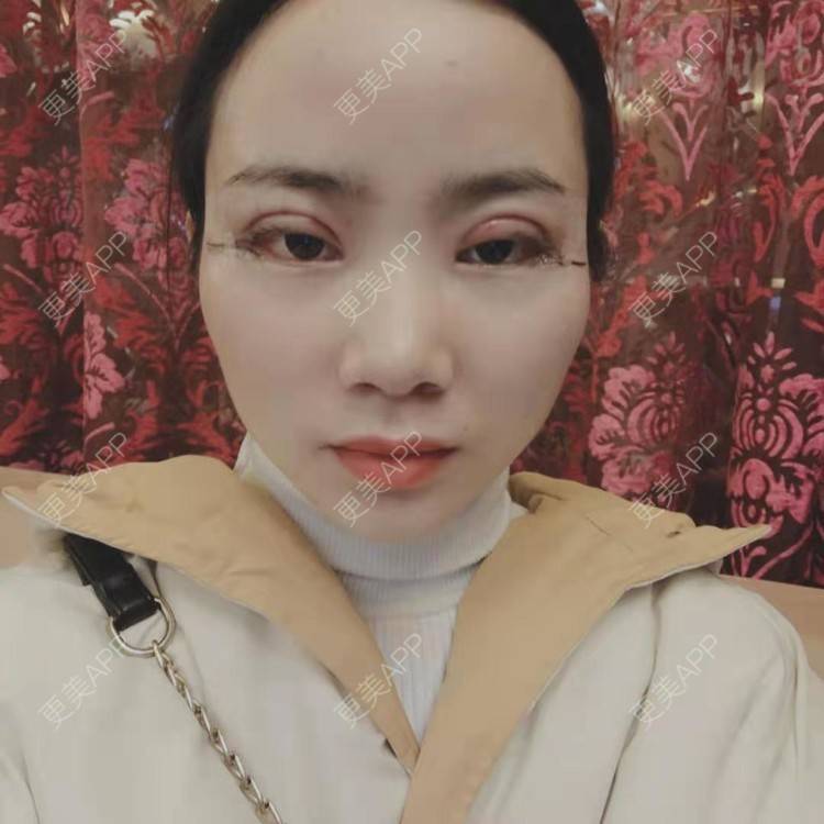 更美 - 更美用户222hTxLwTH的自体脂肪丰卧蚕经验 | 上海 | 自体脂肪丰卧蚕