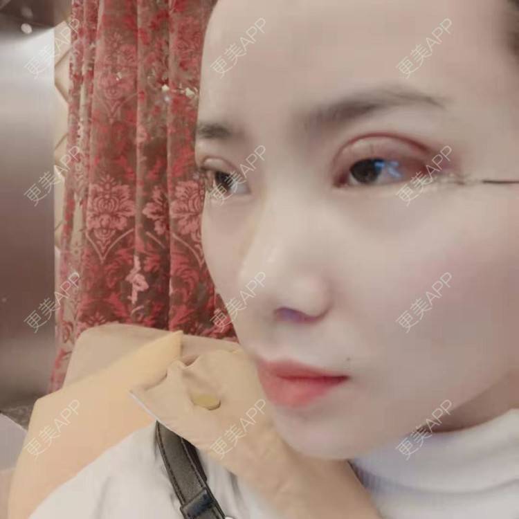 更美 - 更美用户222hTxLwTH的自体脂肪丰卧蚕经验 | 上海 | 自体脂肪丰卧蚕
