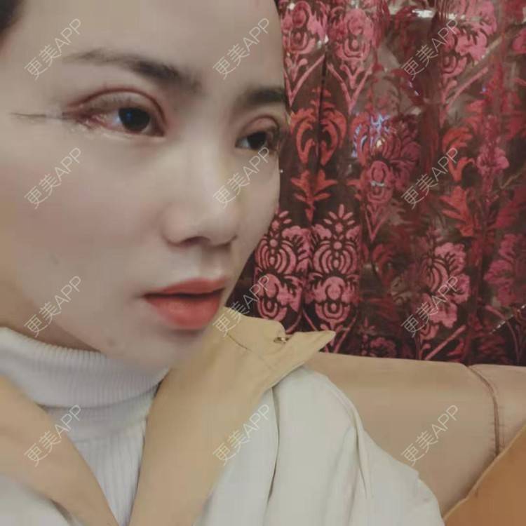 更美 - 更美用户222hTxLwTH的自体脂肪丰卧蚕经验 | 上海 | 自体脂肪丰卧蚕