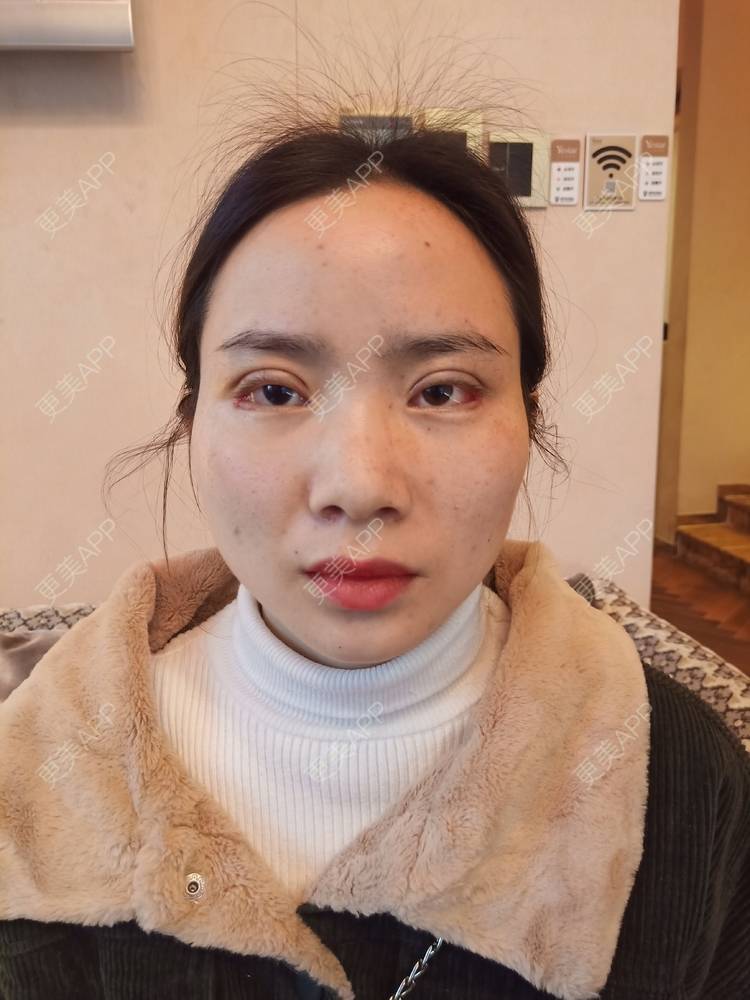 更美 - 更美用户222hTxLwTH的自体脂肪丰卧蚕经验 | 上海 | 自体脂肪丰卧蚕