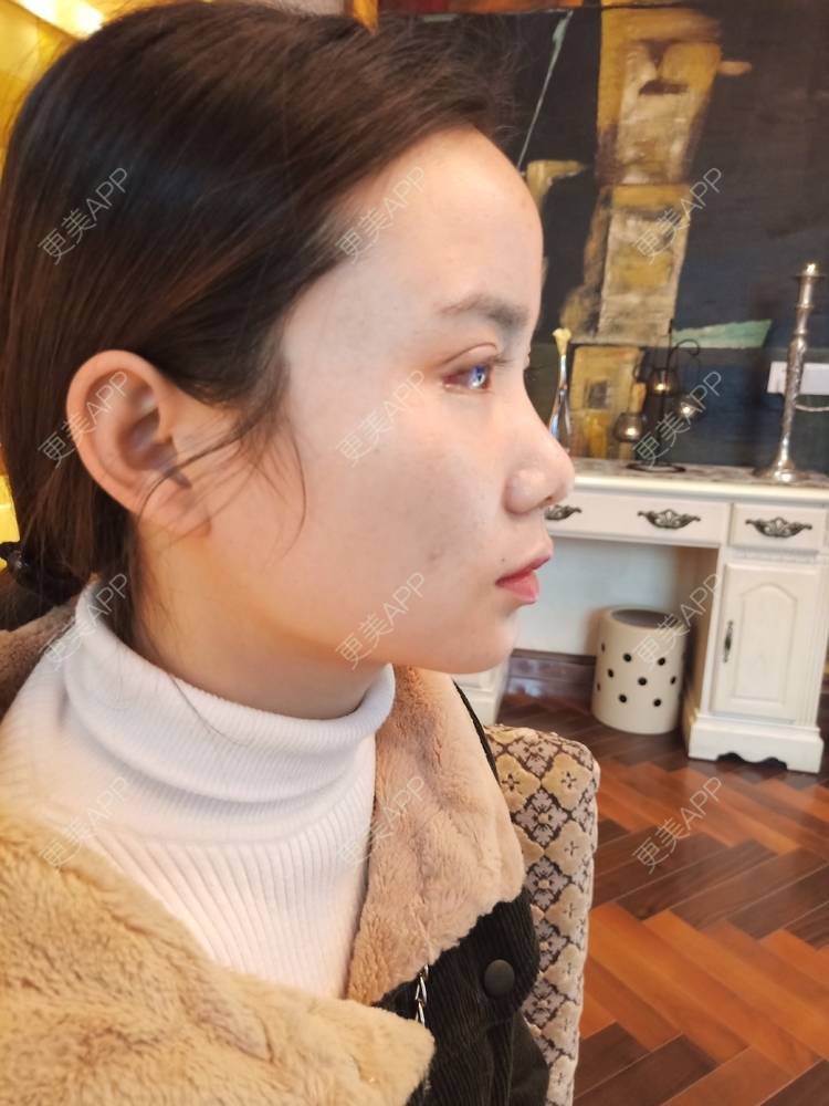 更美 - 更美用户222hTxLwTH的自体脂肪丰卧蚕经验 | 上海 | 自体脂肪丰卧蚕