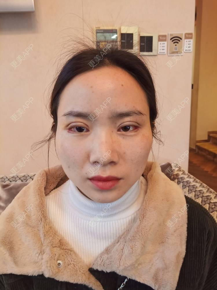 更美 - 更美用户222hTxLwTH的自体脂肪丰卧蚕经验 | 上海 | 自体脂肪丰卧蚕