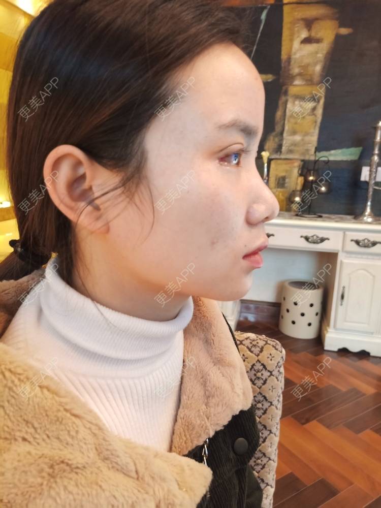 更美 - 更美用户222hTxLwTH的自体脂肪丰卧蚕经验 | 上海 | 自体脂肪丰卧蚕