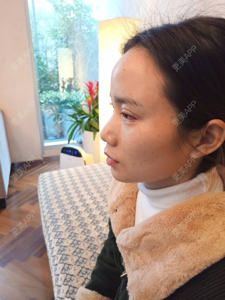 更美 - 更美用户222hTxLwTH的自体脂肪丰卧蚕经验 | 上海 | 自体脂肪丰卧蚕