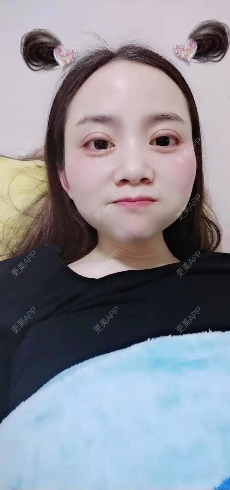 更美 - 更美用户222hTxLwTH的自体脂肪丰卧蚕经验 | 上海 | 自体脂肪丰卧蚕