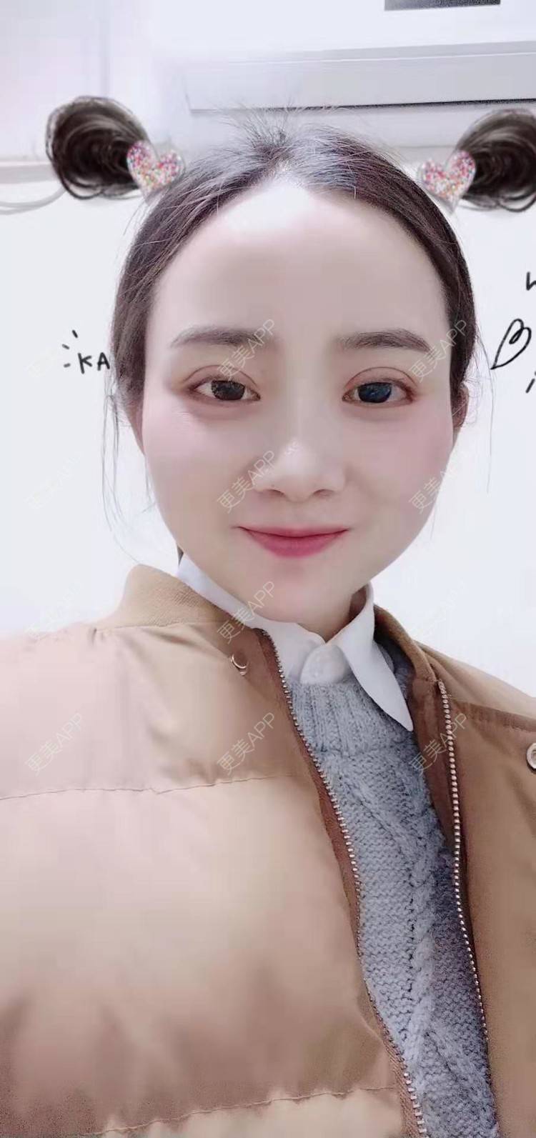 更美 - 更美用户222hTxLwTH的自体脂肪丰卧蚕经验 | 上海 | 自体脂肪丰卧蚕