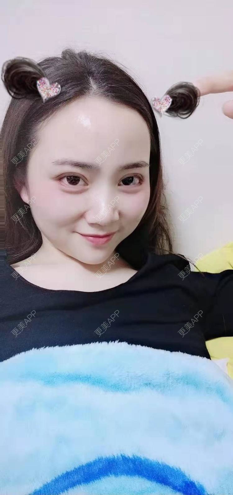更美 - 更美用户222hTxLwTH的自体脂肪丰卧蚕经验 | 上海 | 自体脂肪丰卧蚕