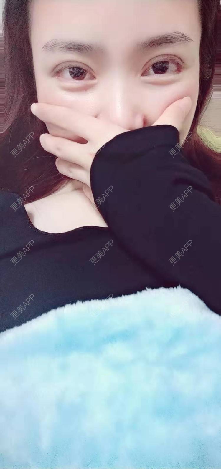 更美 - 更美用户222hTxLwTH的自体脂肪丰卧蚕经验 | 上海 | 自体脂肪丰卧蚕