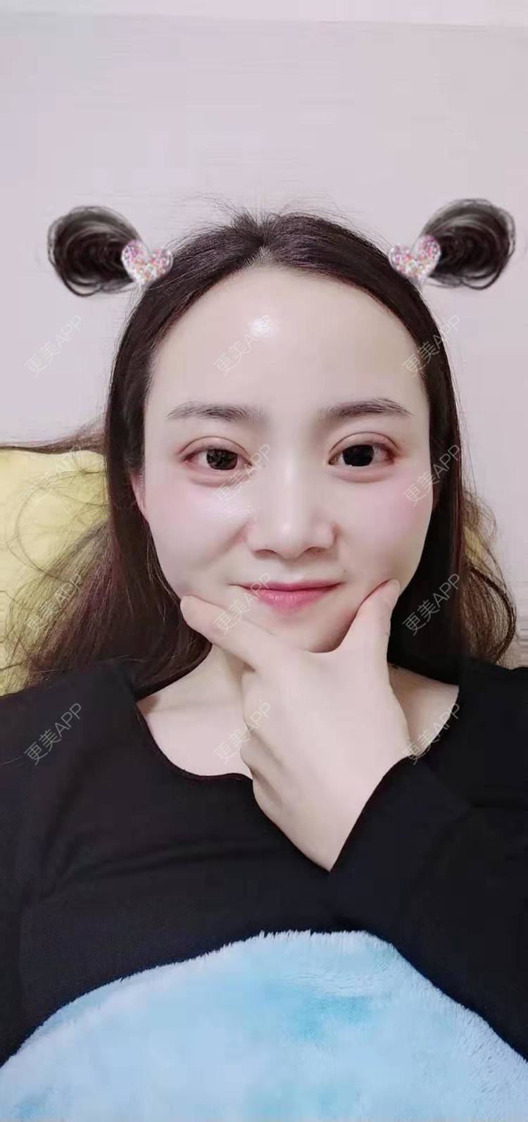 更美 - 更美用户222hTxLwTH的自体脂肪丰卧蚕经验 | 上海 | 自体脂肪丰卧蚕