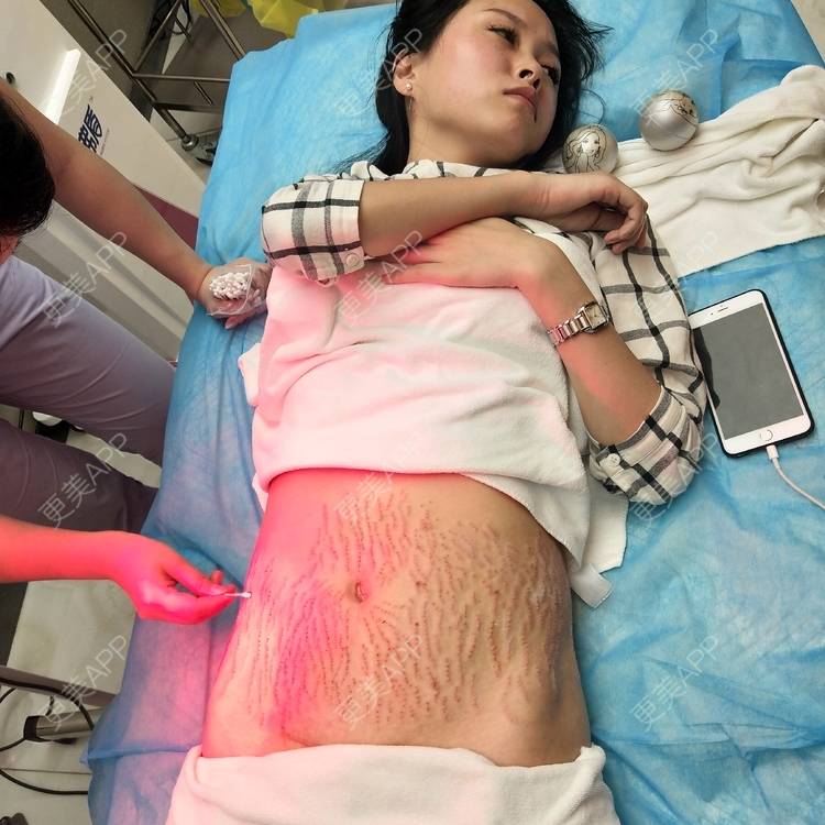 更美 - 是仙女呵的激光淡化妊娠纹经验 | 激光淡化妊娠纹