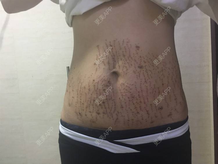 更美 - 是仙女呵的激光淡化妊娠纹经验 | 激光淡化妊娠纹