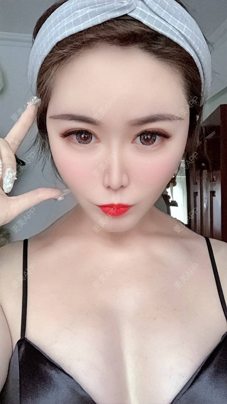更美 - 我是梦鸽的自体脂肪填充泪沟经验 | 自体脂肪丰苹果肌 | 自体脂肪丰面颊 | 自体脂肪丰太阳穴 | 自体脂肪丰额头 | 自体脂肪面部填充 | 自体脂肪填充泪沟 | 温州 | 自体脂肪全面部填充