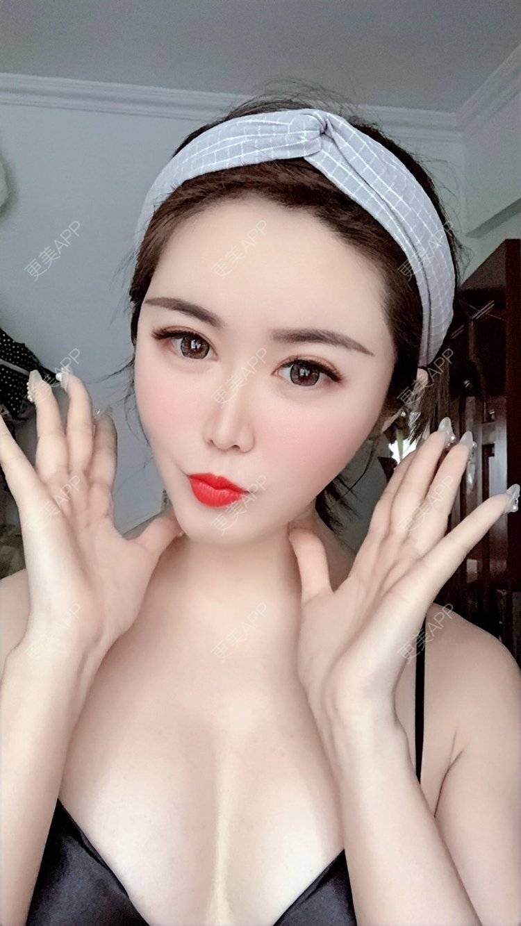 更美 - 我是梦鸽的自体脂肪填充泪沟经验 | 自体脂肪丰苹果肌 | 自体脂肪丰面颊 | 自体脂肪丰太阳穴 | 自体脂肪丰额头 | 自体脂肪面部填充 | 自体脂肪填充泪沟 | 温州 | 自体脂肪全面部填充