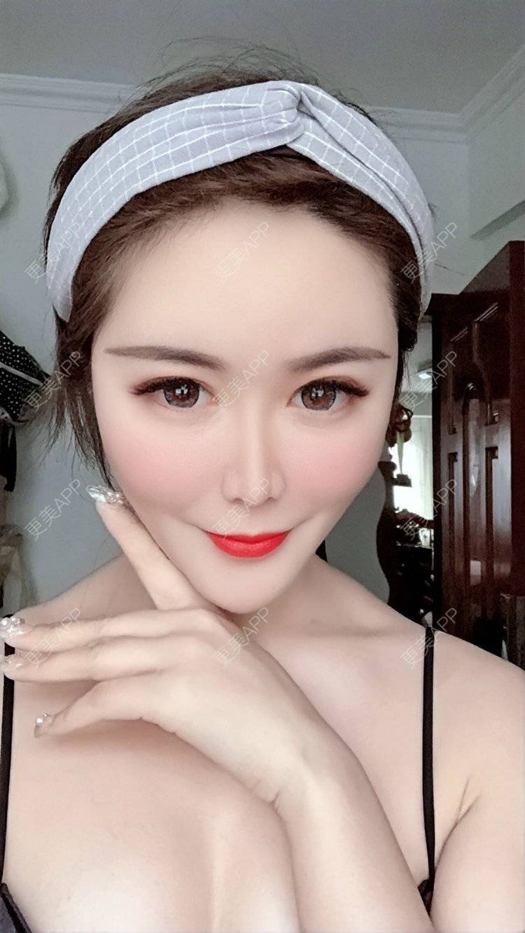 更美 - 我是梦鸽的自体脂肪填充泪沟经验 | 自体脂肪丰苹果肌 | 自体脂肪丰面颊 | 自体脂肪丰太阳穴 | 自体脂肪丰额头 | 自体脂肪面部填充 | 自体脂肪填充泪沟 | 温州 | 自体脂肪全面部填充