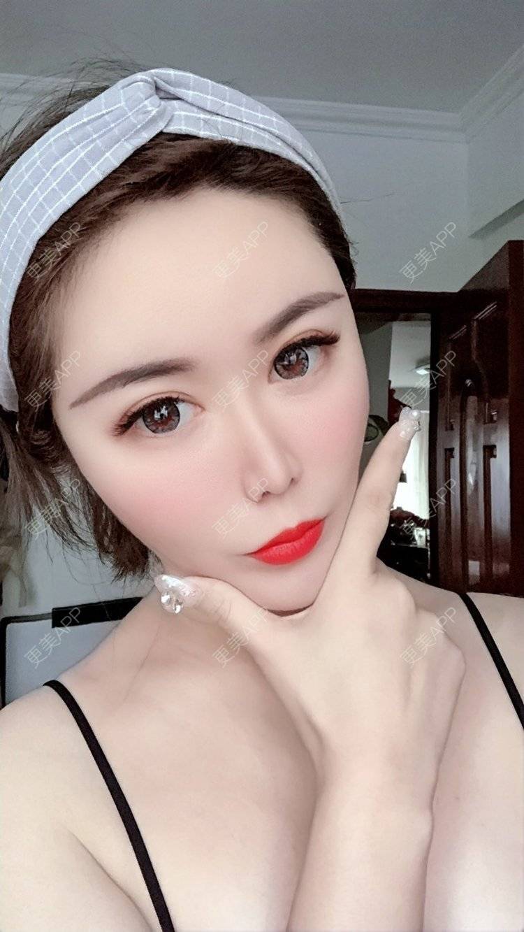 更美 - 我是梦鸽的自体脂肪填充泪沟经验 | 自体脂肪丰苹果肌 | 自体脂肪丰面颊 | 自体脂肪丰太阳穴 | 自体脂肪丰额头 | 自体脂肪面部填充 | 自体脂肪填充泪沟 | 温州 | 自体脂肪全面部填充