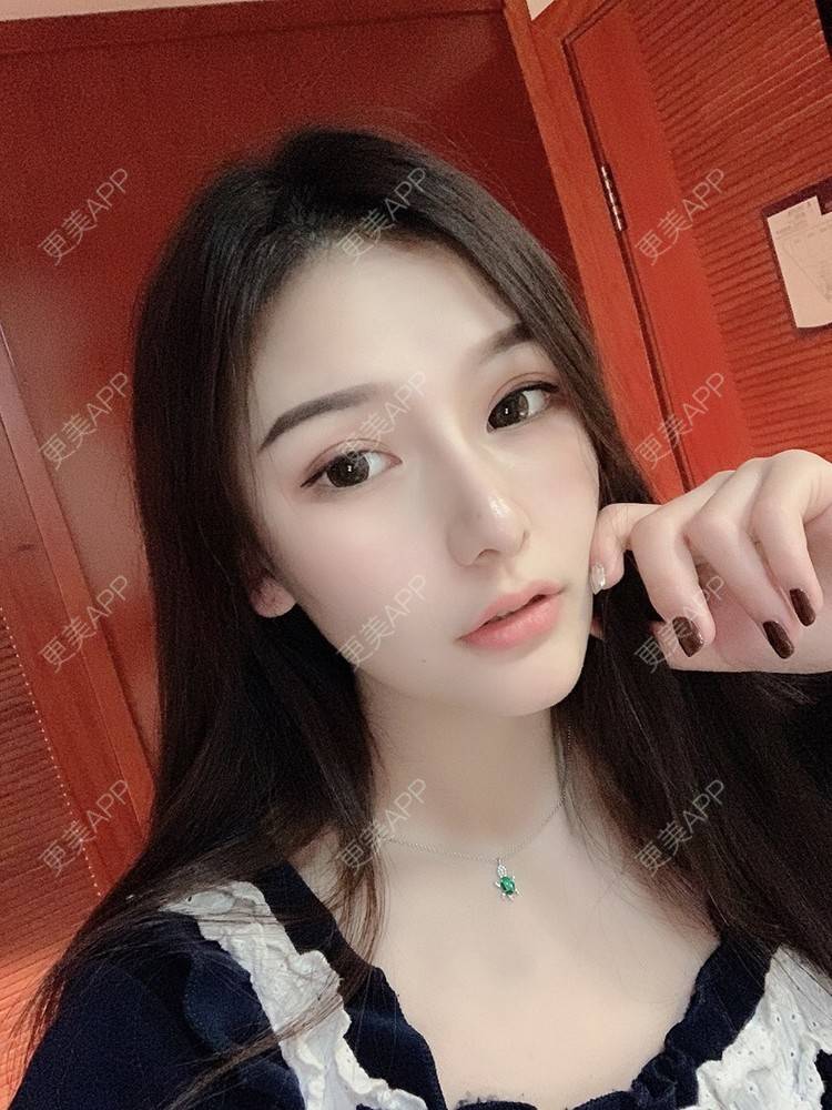 更美 - 大头大头A的自体脂肪全面部填充经验 | 自体脂肪丰面颊 | 自体脂肪丰太阳穴 | 自体脂肪丰额头 | 自体脂肪垫下巴 | 自体脂肪填充泪沟 | 自体脂肪丰苹果肌 | 温州 | 自体脂肪全面部填充 | 自体脂肪面部填充
