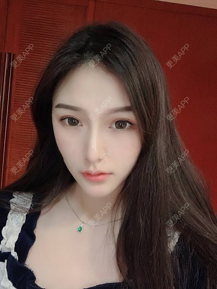 更美 - 大头大头A的自体脂肪全面部填充经验 | 自体脂肪丰面颊 | 自体脂肪丰太阳穴 | 自体脂肪丰额头 | 自体脂肪垫下巴 | 自体脂肪填充泪沟 | 自体脂肪丰苹果肌 | 温州 | 自体脂肪全面部填充 | 自体脂肪面部填充