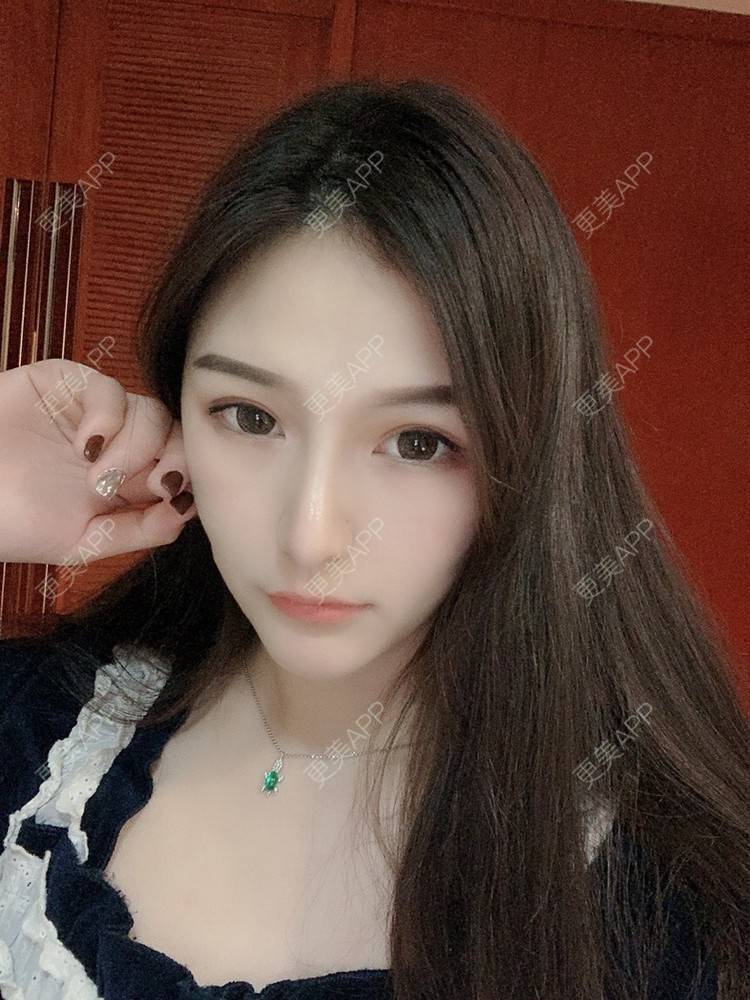 更美 - 大头大头A的自体脂肪全面部填充经验 | 自体脂肪丰面颊 | 自体脂肪丰太阳穴 | 自体脂肪丰额头 | 自体脂肪垫下巴 | 自体脂肪填充泪沟 | 自体脂肪丰苹果肌 | 温州 | 自体脂肪全面部填充 | 自体脂肪面部填充