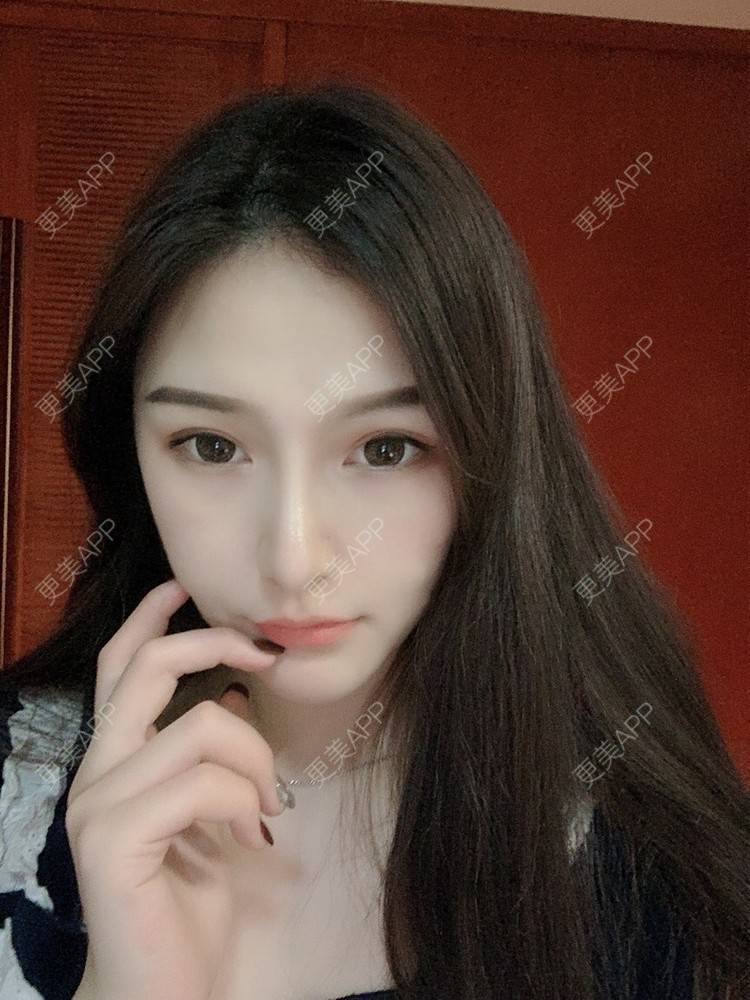 更美 - 大头大头A的自体脂肪全面部填充经验 | 自体脂肪丰面颊 | 自体脂肪丰太阳穴 | 自体脂肪丰额头 | 自体脂肪垫下巴 | 自体脂肪填充泪沟 | 自体脂肪丰苹果肌 | 温州 | 自体脂肪全面部填充 | 自体脂肪面部填充