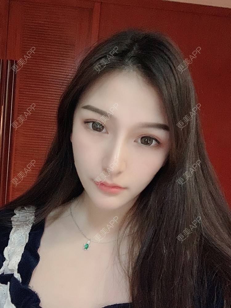 更美 - 大头大头A的自体脂肪全面部填充经验 | 自体脂肪丰面颊 | 自体脂肪丰太阳穴 | 自体脂肪丰额头 | 自体脂肪垫下巴 | 自体脂肪填充泪沟 | 自体脂肪丰苹果肌 | 温州 | 自体脂肪全面部填充 | 自体脂肪面部填充