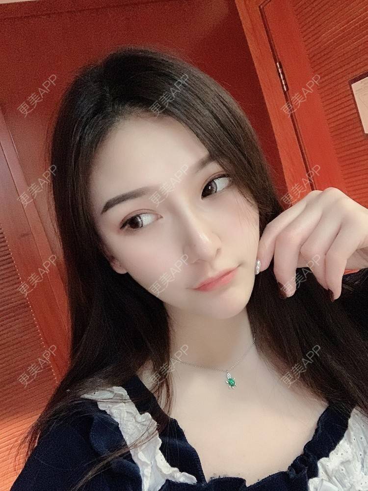 更美 - 大头大头A的自体脂肪全面部填充经验 | 自体脂肪丰面颊 | 自体脂肪丰太阳穴 | 自体脂肪丰额头 | 自体脂肪垫下巴 | 自体脂肪填充泪沟 | 自体脂肪丰苹果肌 | 温州 | 自体脂肪全面部填充 | 自体脂肪面部填充