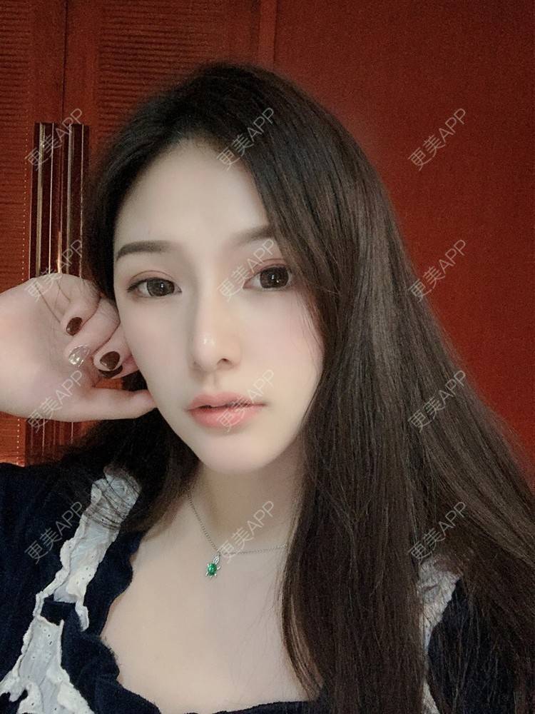 更美 - 大头大头A的自体脂肪全面部填充经验 | 自体脂肪丰面颊 | 自体脂肪丰太阳穴 | 自体脂肪丰额头 | 自体脂肪垫下巴 | 自体脂肪填充泪沟 | 自体脂肪丰苹果肌 | 温州 | 自体脂肪全面部填充 | 自体脂肪面部填充