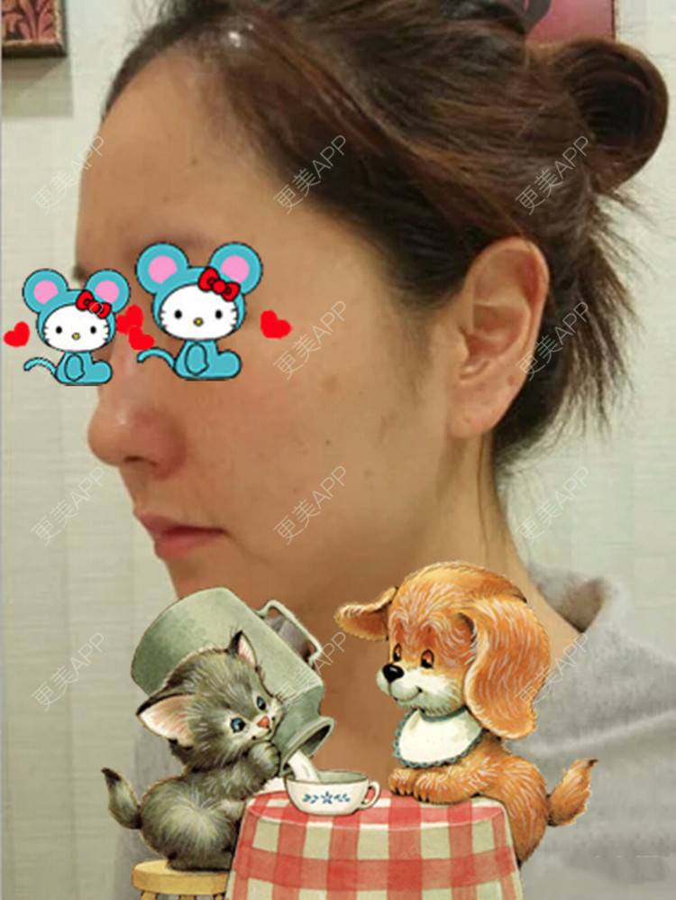 更美 - 珠海熙尔曼医疗美容的鼻部多项经验 | 鼻部多项