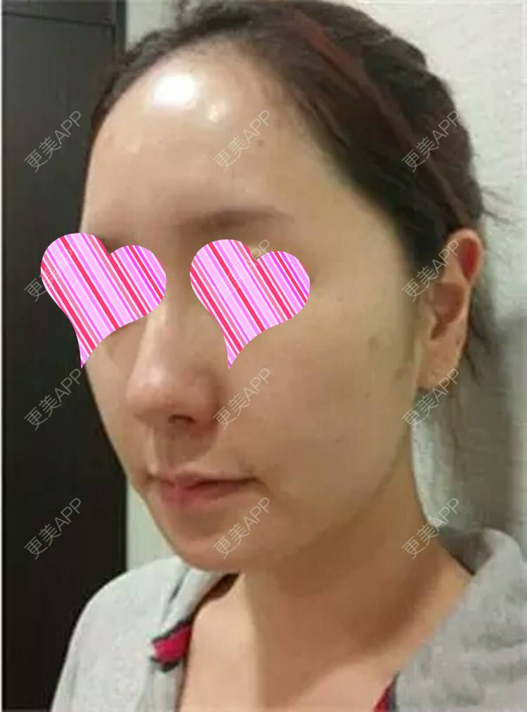 更美 - 珠海熙尔曼医疗美容的鼻部多项经验 | 鼻部多项