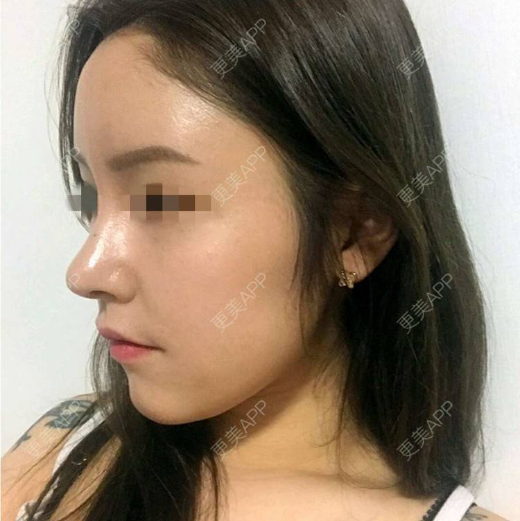 更美 - 珠海熙尔曼医疗美容的肋软骨隆鼻经验 | 肋软骨隆鼻