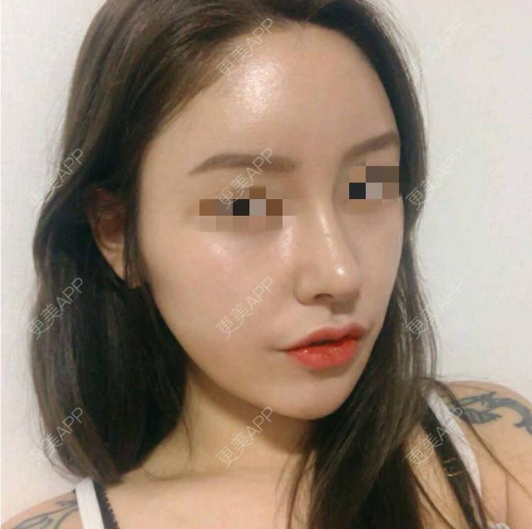 更美 - 珠海熙尔曼医疗美容的肋软骨隆鼻经验 | 肋软骨隆鼻