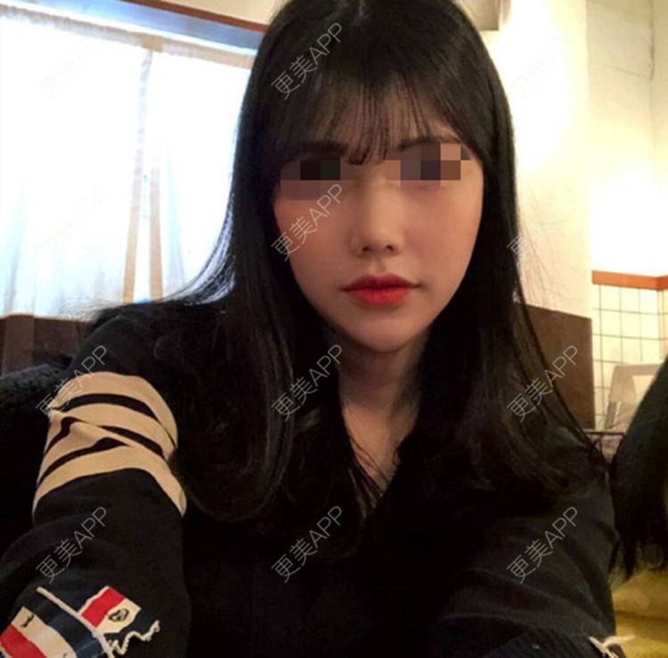 更美 - 珠海熙尔曼医疗美容的膨体隆鼻经验 | 膨体隆鼻