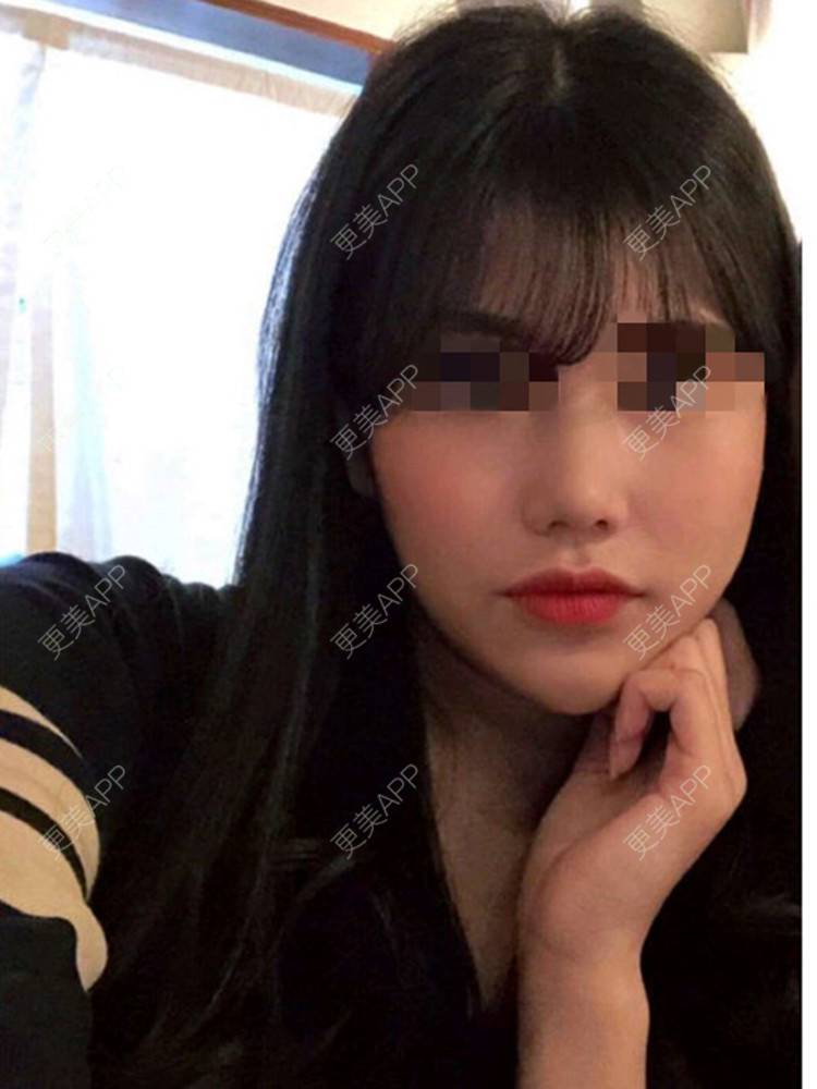 更美 - 珠海熙尔曼医疗美容的膨体隆鼻经验 | 膨体隆鼻