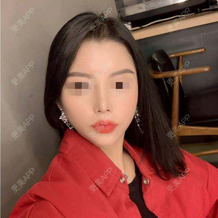 更美 - 珠海熙尔曼医疗美容的鼻部综合经验 | 鼻部综合
