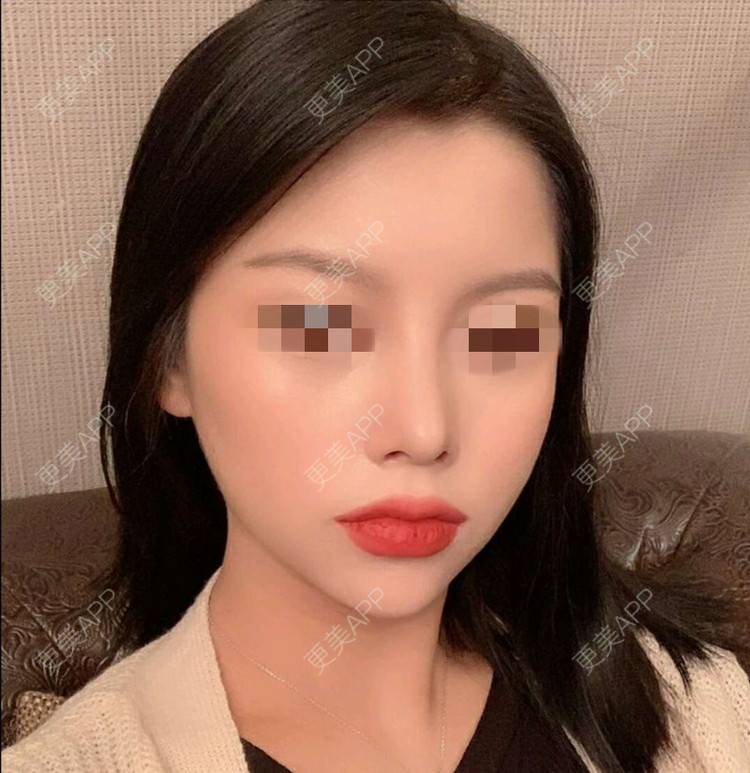 更美 - 珠海熙尔曼医疗美容的鼻部综合经验 | 鼻部综合