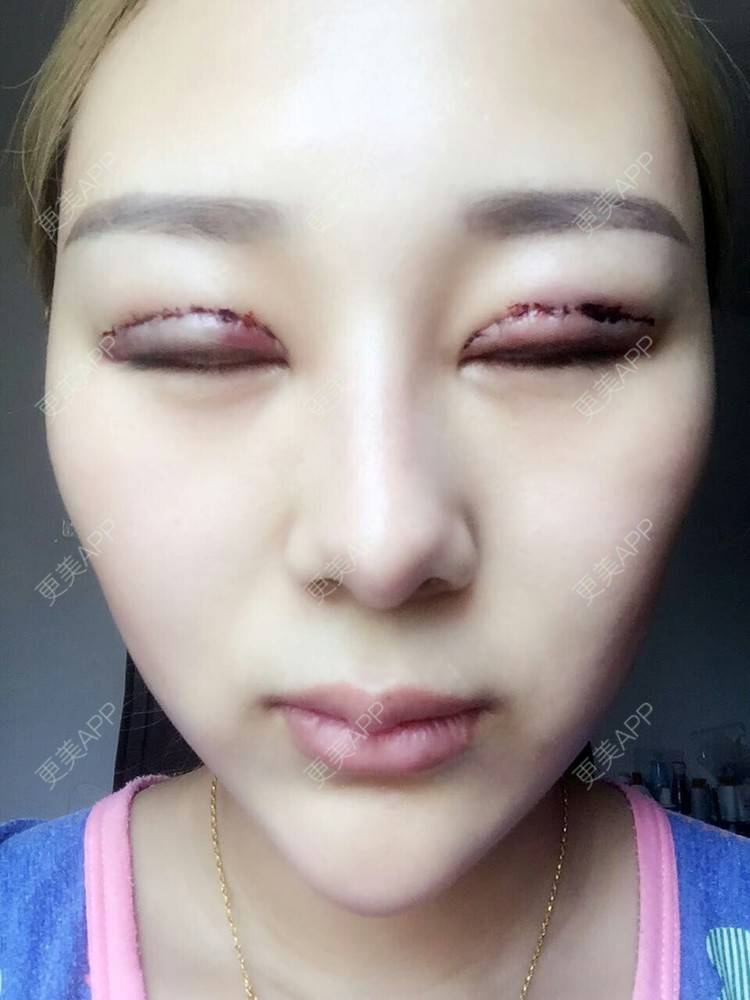 更美用户kru34srshy的全切双眼皮日记