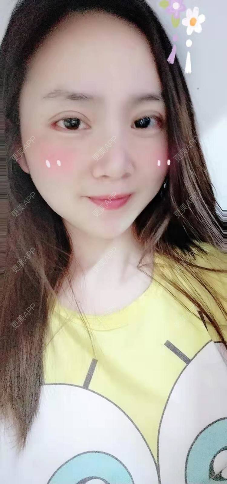 更美 - 更美用户222hTxLwTH的自体脂肪丰卧蚕经验 | 上海 | 自体脂肪丰卧蚕