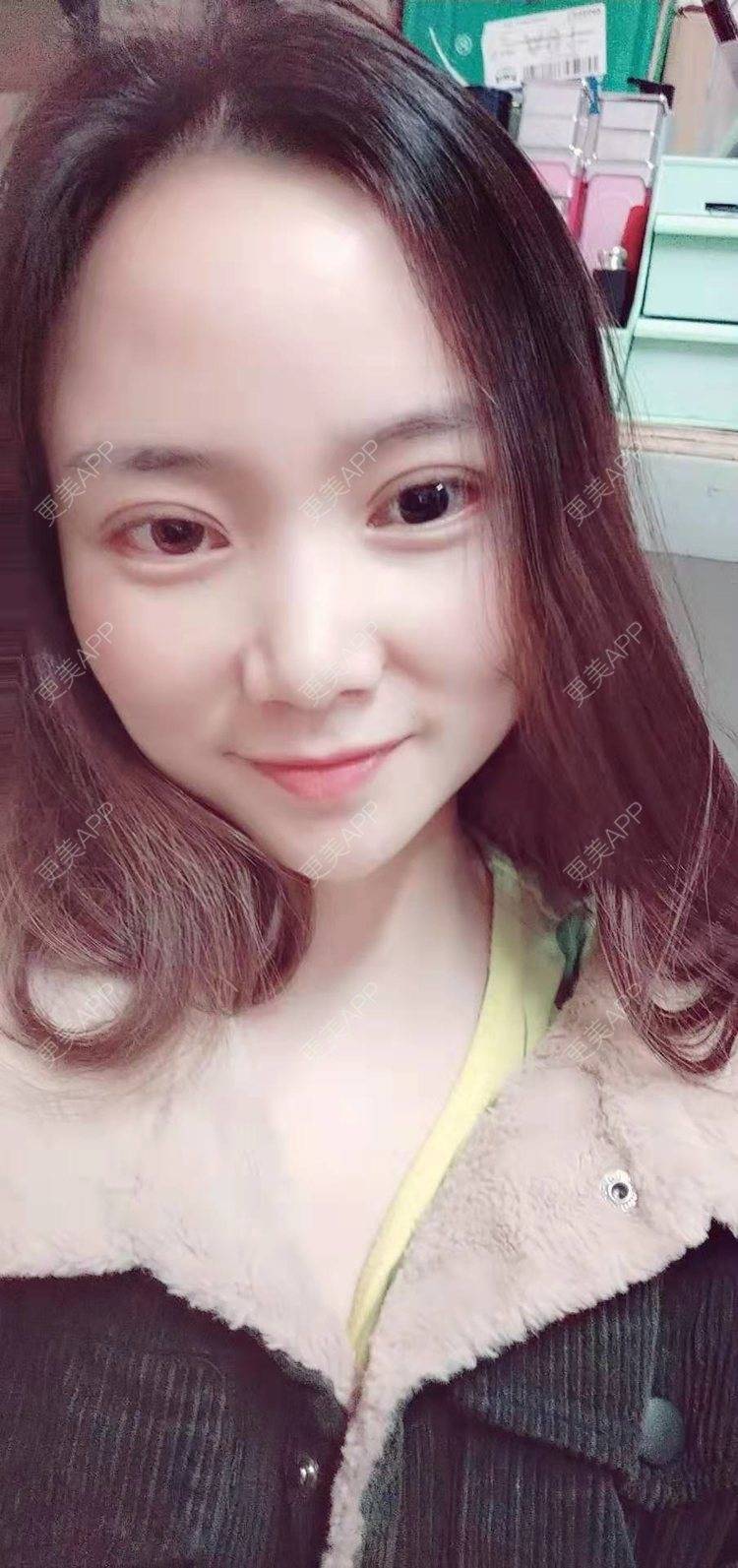 更美 - 更美用户222hTxLwTH的自体脂肪丰卧蚕经验 | 上海 | 自体脂肪丰卧蚕